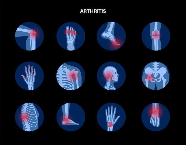 Neuropathic Pain Syndromes: A Comprehensive Review of Current Research