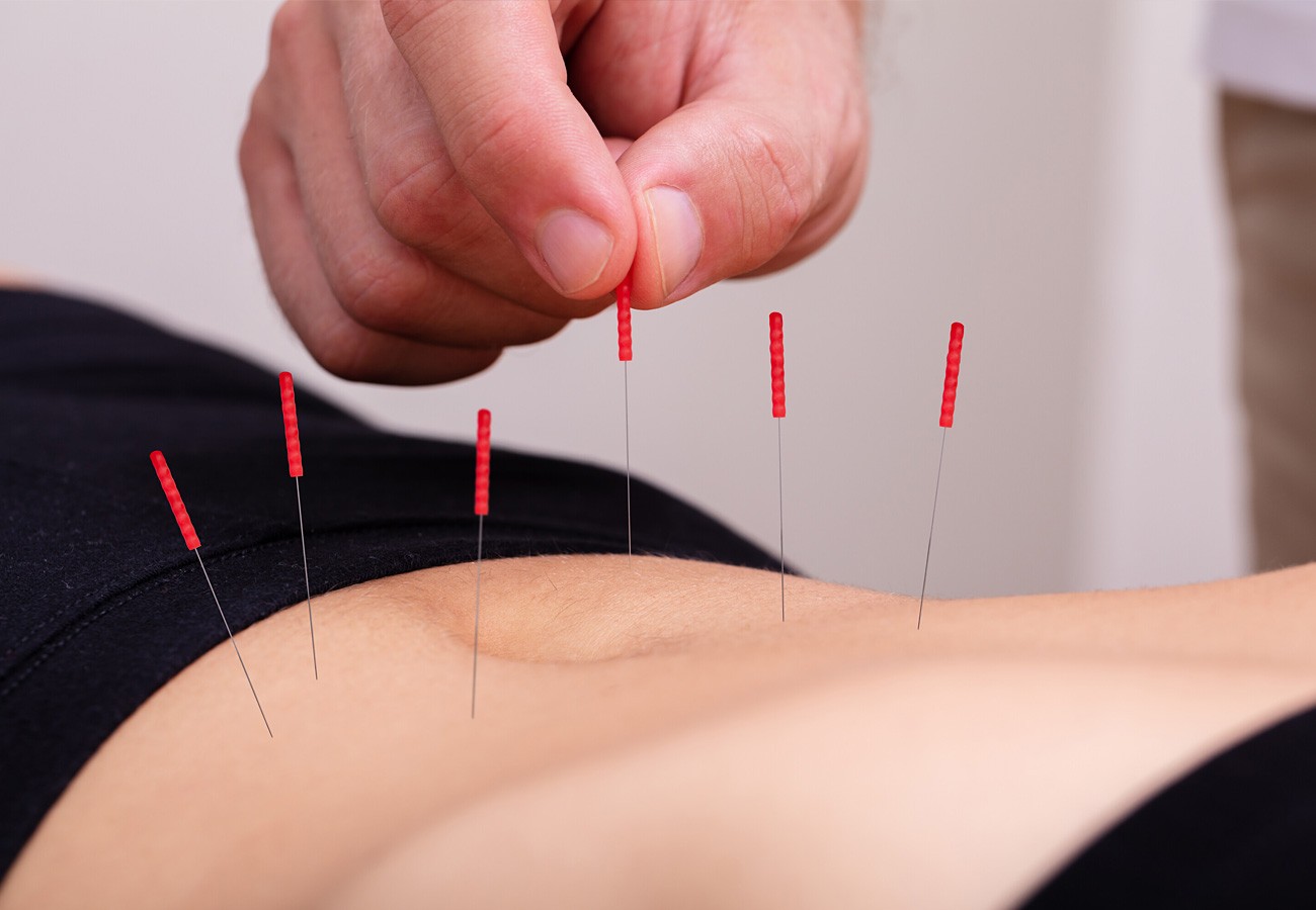 Natural Strategies: Acupuncture for Fertility Support Explained