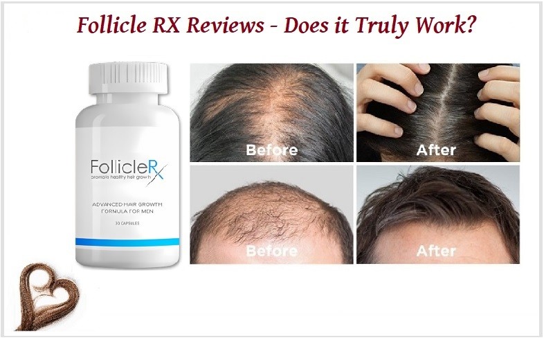 Follicle RX 리뷰(100% 모발 성장): 남성이 꼭 사용해야 합니다!