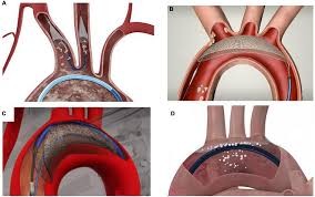 Embolic Protection Device Market Analysis Size And Forecast Report 2024-2032