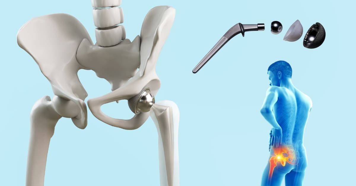 Hip Replacement Price in Pakistan – A Complete Guide to Costs & Quality Care