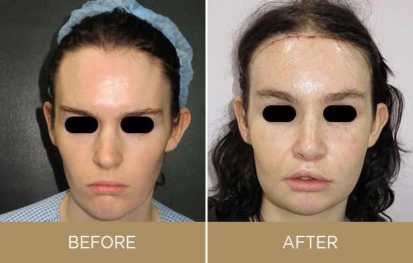 5 Transformations One Can See After Facial Feminization Surgery