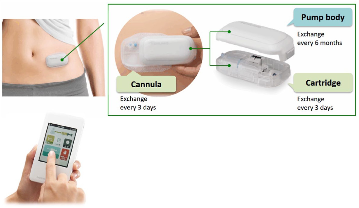Challenges and Opportunities in the Tubeless Insulin Pump Market