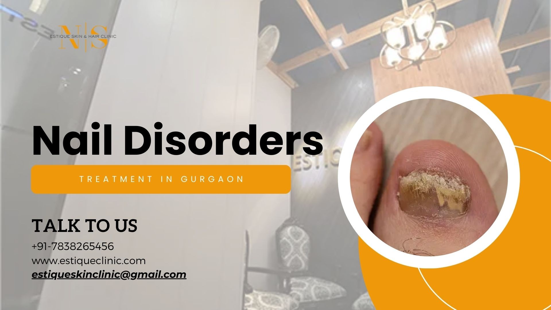 Treatment Options For Fungal Nail Disorder